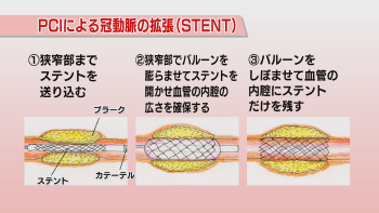 PCIによる冠動脈の拡張(STENT)